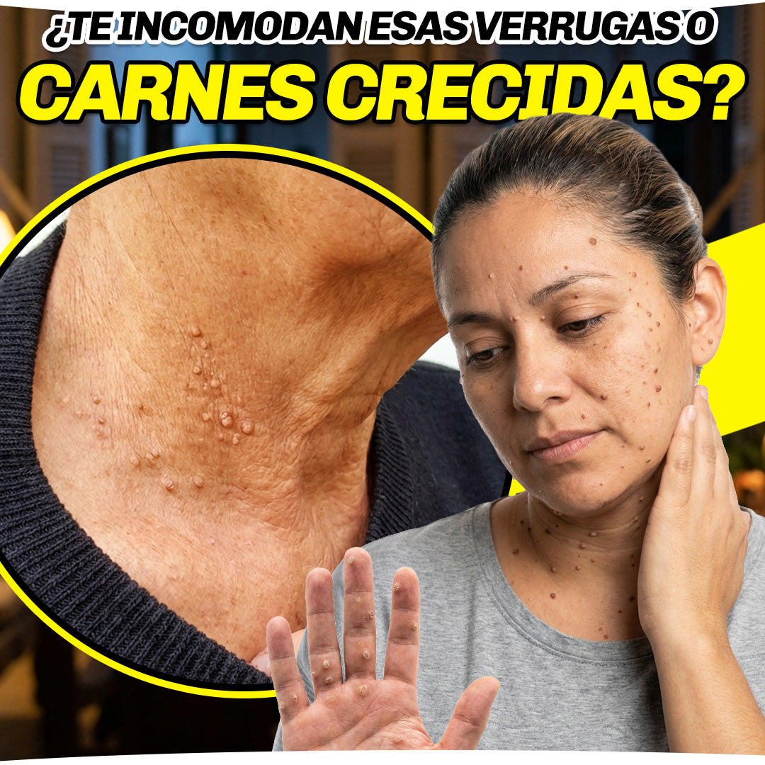 Recupera tu piel en pocos días | Spray Eliminador de Verrugas 🐝